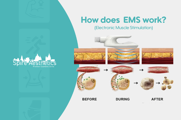 EMS treatment for post pregnancy weight loss treatment Ampthill