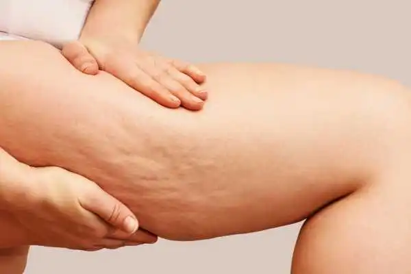 Image of woman showing leg with cellulite Ampthill