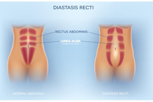 What Non-Surgical Options Are Available for Diastasis Recti Ampthill?