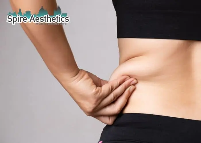 Image of woman pinching fat on their hips Ampthill. Fat Freezing treatment 