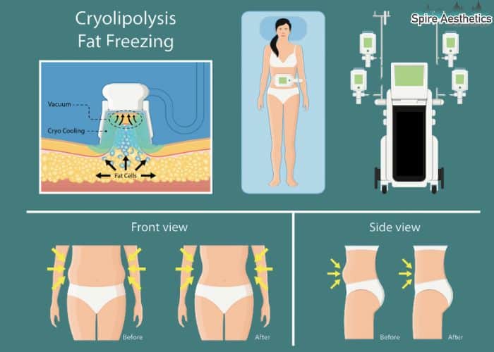 Image of diet and fat freezing combined for best results for Spire Aesthetics Ampthill