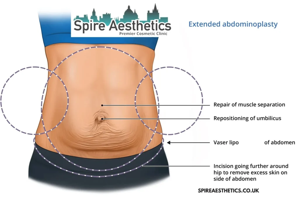 Understanding Loose Skin After Gastric Band Ampthill Surgery and HIFU Treatment