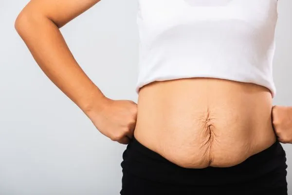 Image of a woman's stomach after weight loss with sagging skin following a gastric band Ampthill