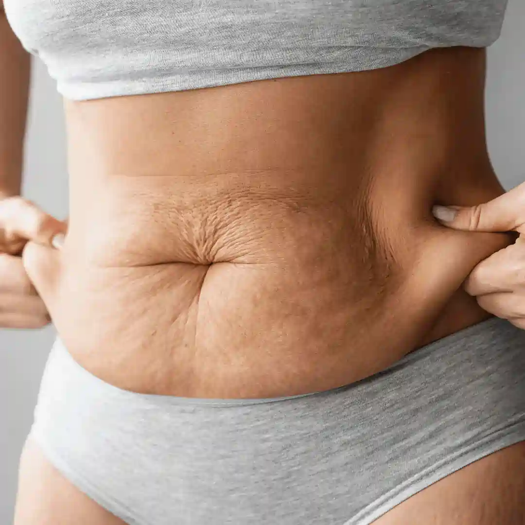 Is It Normal to Have Loose Skin After Pregnancy Ampthill?