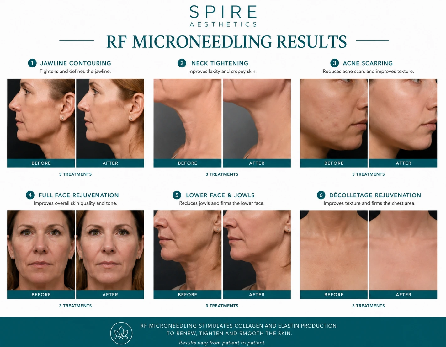 RF Microneedling Skin tightening Ampthill results