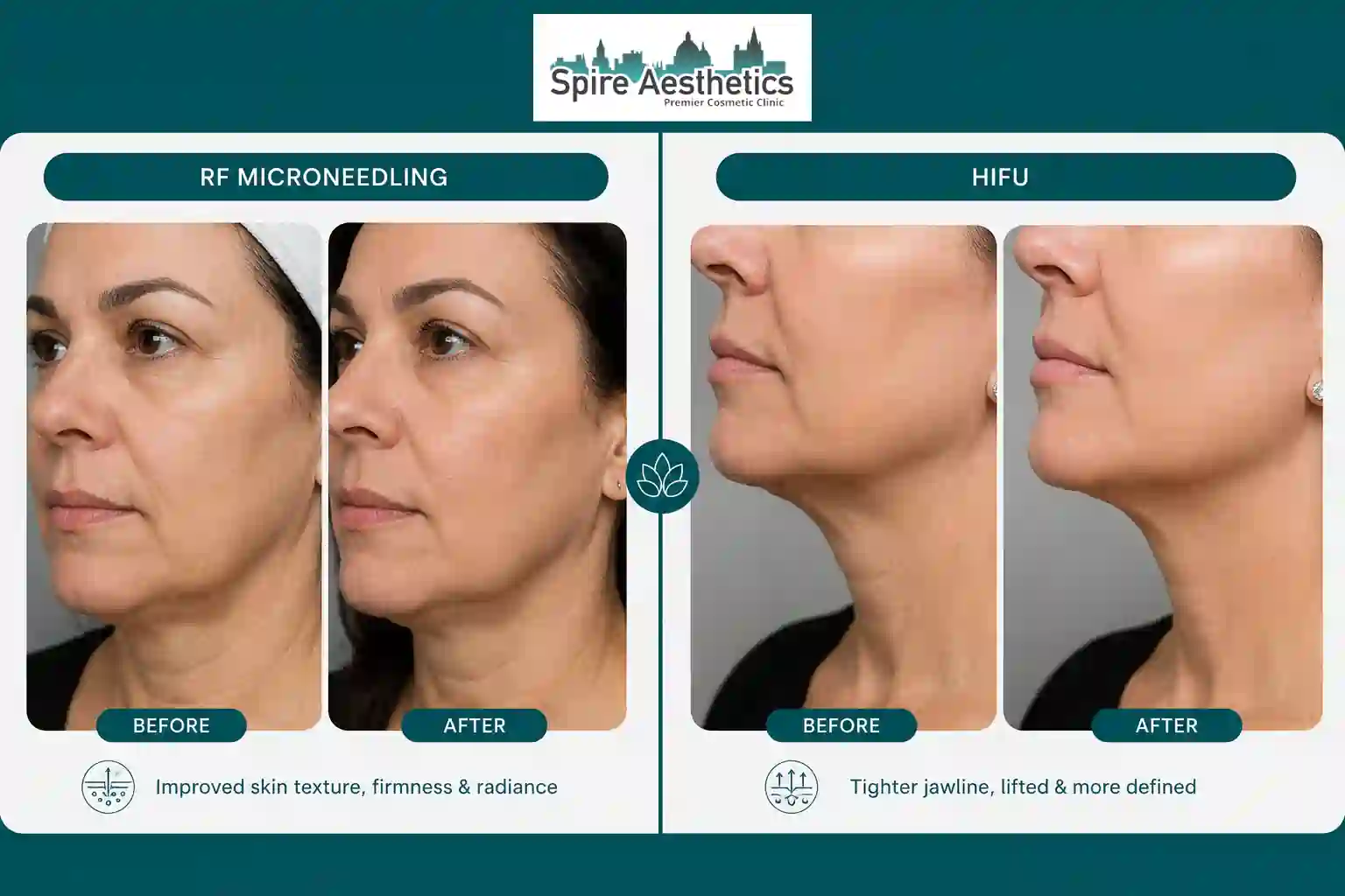Can RF Microneedling and HIFU Be Combined Ampthill?