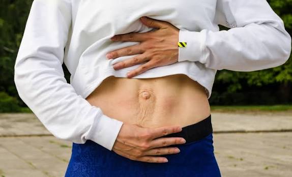 When Could Diastasis Recti Be the Missing Piece of the Puzzle Ampthill?